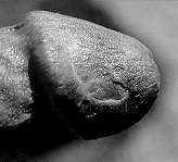 Circumcision Damage - Gouges in Glans (25 KB)