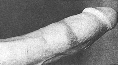 Circumcision Damage - Scar (33 KB)