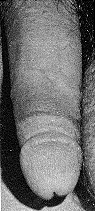 Circumcision Damage - Skin Tone Variance (26 KB)
